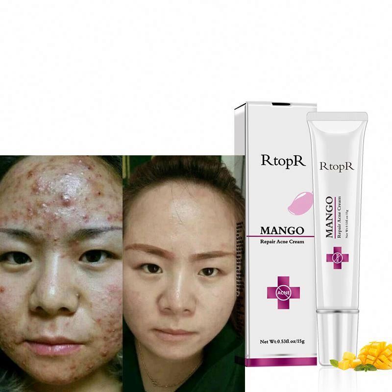 Quick Acne Pimples Care Scar Treatment Spot Removal Anti Acne Herbal Cream